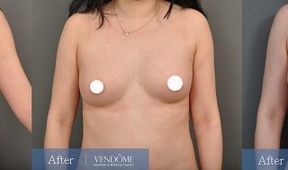 療程效果因人而異，上圖為A罩杯女性在做完自體脂肪隆乳之後​手術後六個月、手術後一年六個月成效